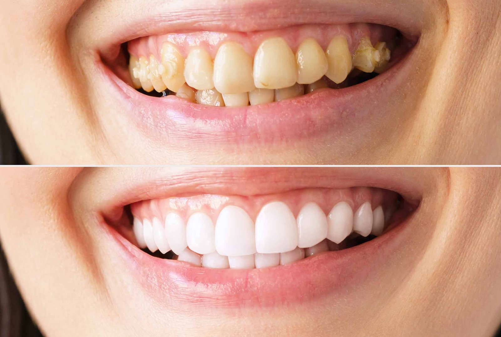 Gummy Smile Correction